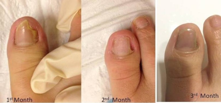 PACT - Fungal Problem by Month - The Sole Clinic