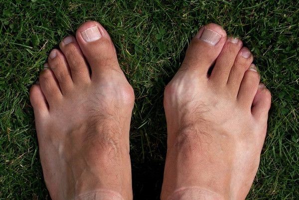 5 Common Misunderstandings about Bunions