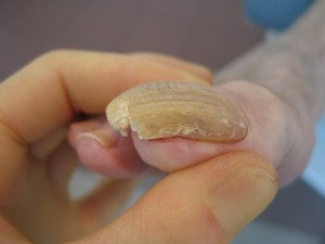 Feet Changing - Nail Deformed - The Sole Clinic