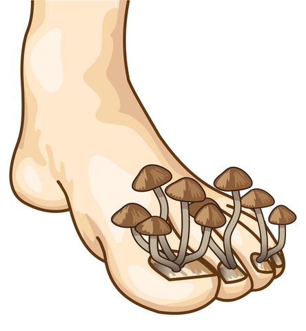 PACT to the Rescue of Fungal Nails!
