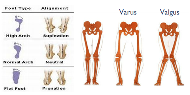 Physiotherapy for Knee Pain - Foot Type - The Sole Clinic