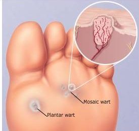 Same Same But Different - Wart Photo - The Sole Clinic