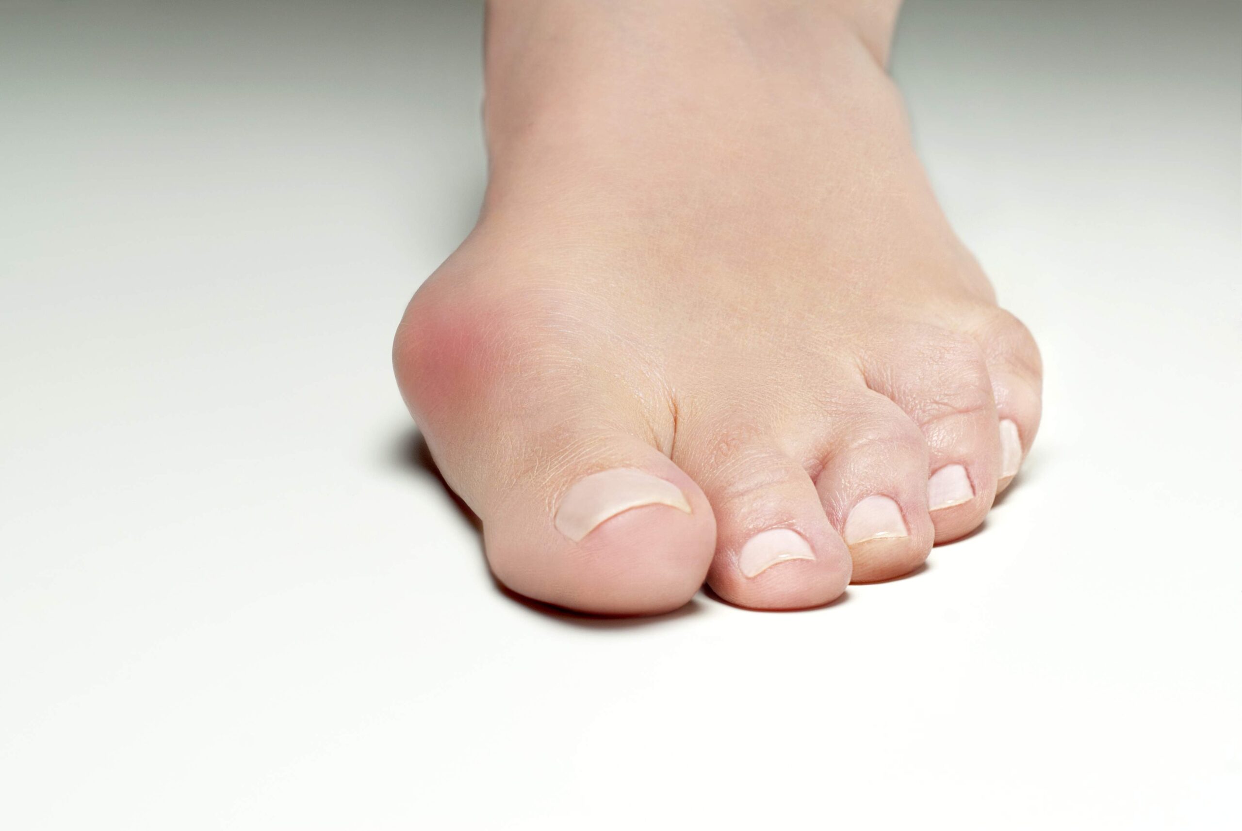Bunion 拇趾外翻