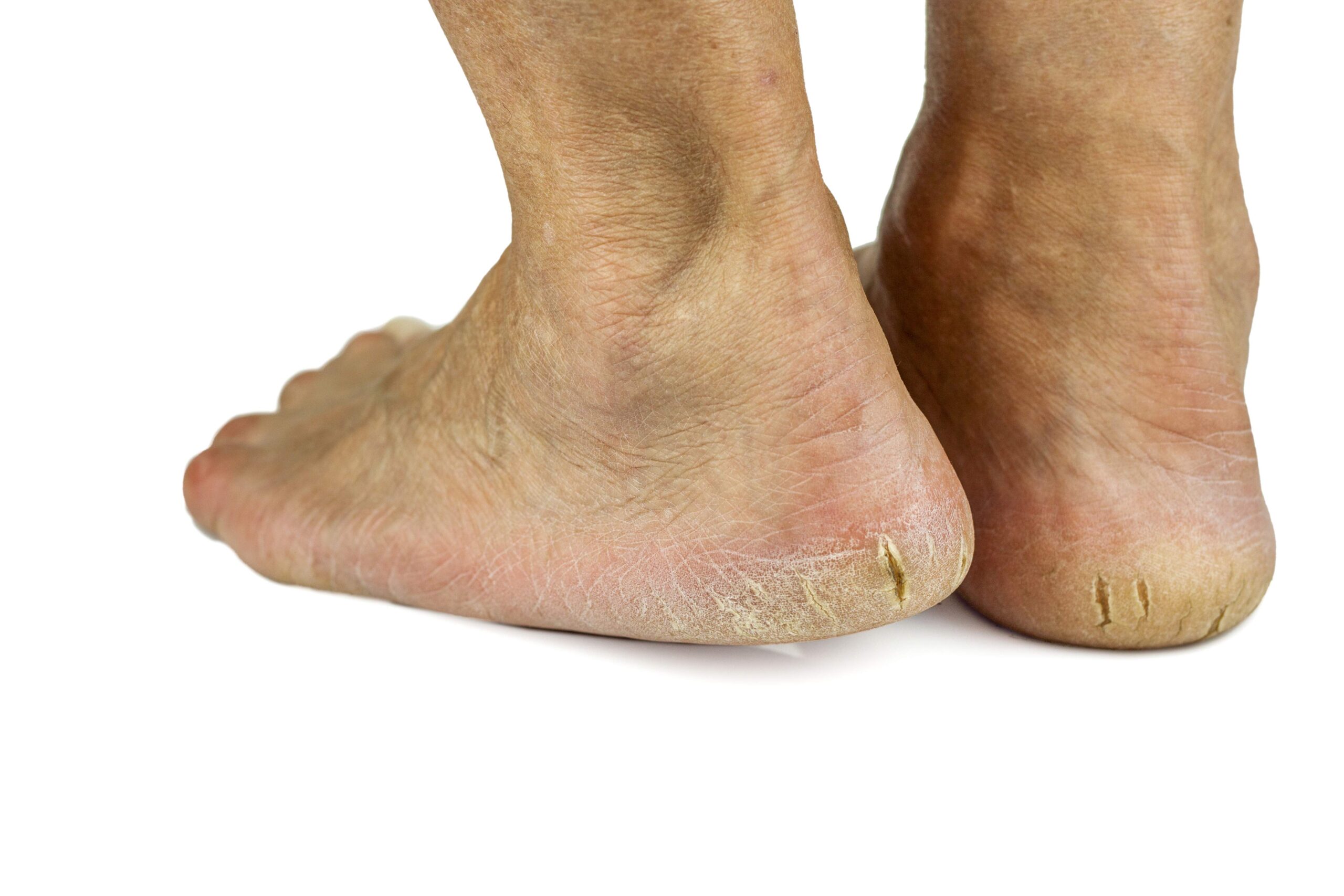 Bare heels showing dry, thickened skin splitting around the rim