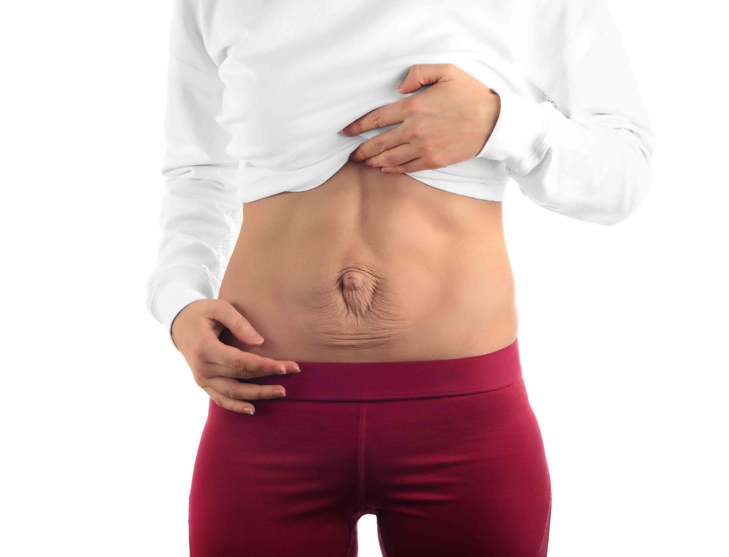 Diastasis of Rectus Abdominis Muscle (DRAM)/ Abdominal Separation﻿