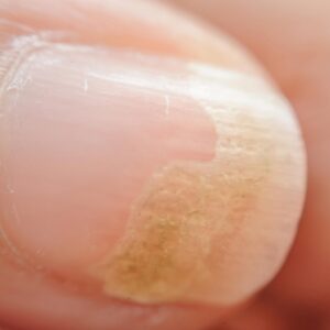 Fungal Nail Infection podiatry treatment