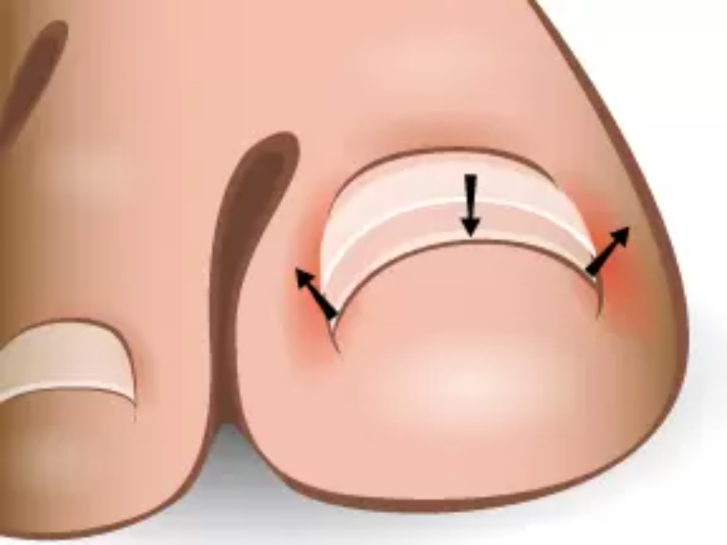 Nail Bracing: Pain-free Treatment for your Ingrown Toenails!