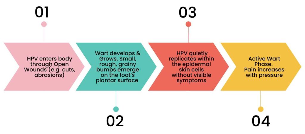 A four-step infographic detailing the progression of plantar warts. Step 1: HPV enters through open wounds like cuts or abrasions. Step 2: Small, rough, grainy bumps develop on the foot's plantar surface. Step 3: The virus replicates within skin cells without visible symptoms. Step 4: The wart enters the active phase, causing increased pain with pressure.