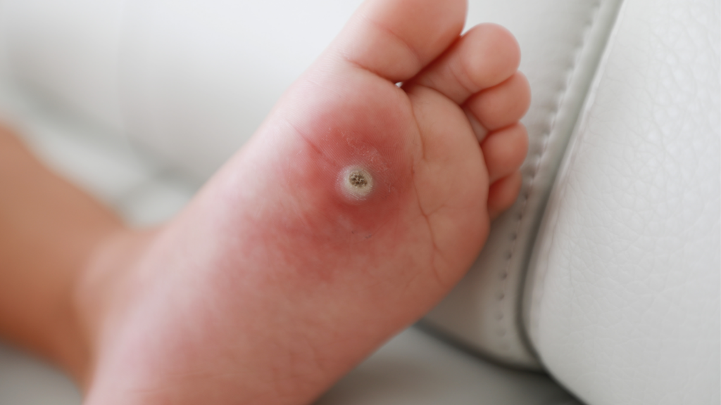 Close-up image of a plantar wart on a child’s foot, showing a raised, circular lesion with a rough surface. Plantar warts, caused by the human papillomavirus (HPV), can be painful and require proper treatment to prevent spreading and discomfort while walking.
