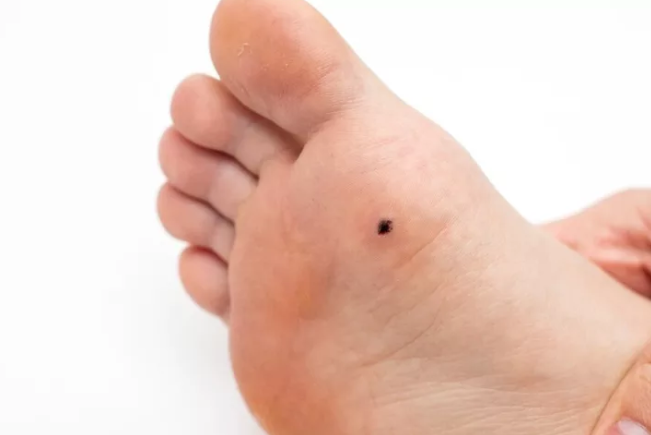 Close-up of a single plantar wart on the sole of a foot, known as a solitary plantar wart. This type of wart is more isolated but can still cause discomfort and pain when walking.