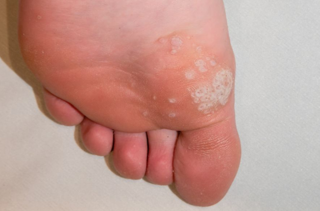 Close-up of multiple clustered plantar warts on the sole of a foot, known as mosaic plantar warts. These warts form in groups and can be more challenging to treat due to their spread across a larger area.