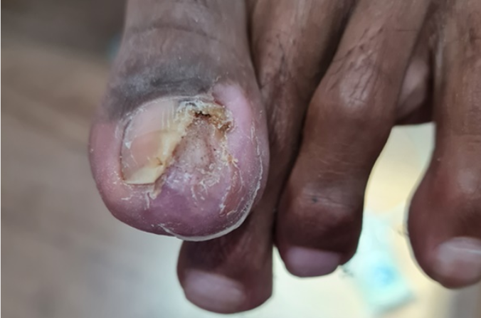 Close-up of a severely infected toenail with partial nail loss, discoloration, and visible tissue damage. The affected toe appears swollen, with signs of infection and possible fungal involvement. Immediate podiatric care is essential to prevent further complications.