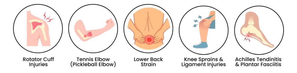 Infographic of pickleball injuries: rotator cuff, elbow pain, lower back strain, knee sprain, plantar fasciitis