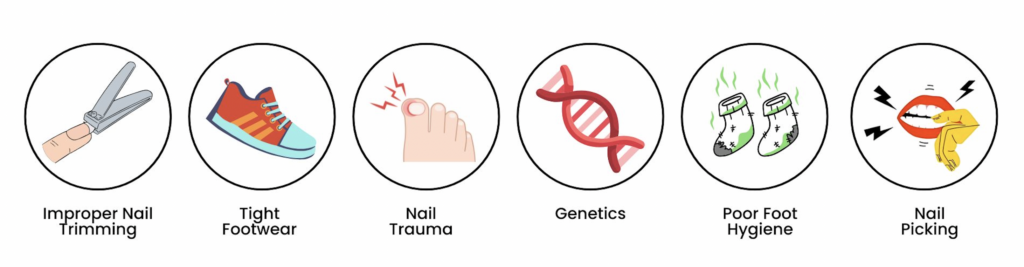 Icons showing causes of ingrown toenails: improper nail trimming, tight shoes, nail trauma, genetics, poor hygiene, and nail picking.