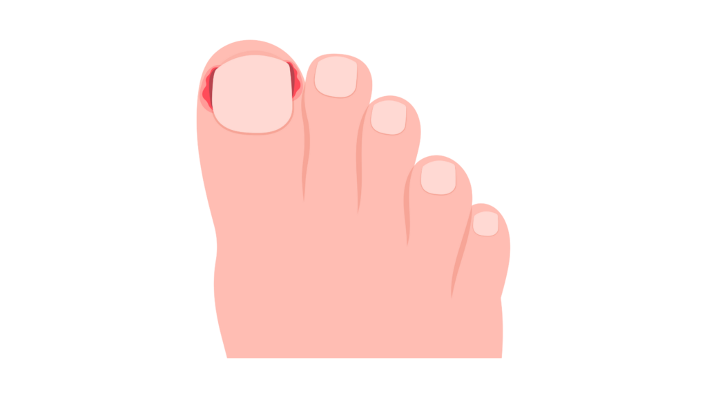 Illustration of a toe with an ingrown toenail showing redness on both sides.
