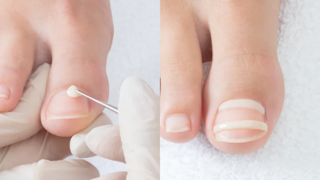Podiatrist applying a nail correction brace to a toenail to treat an ingrown nail.