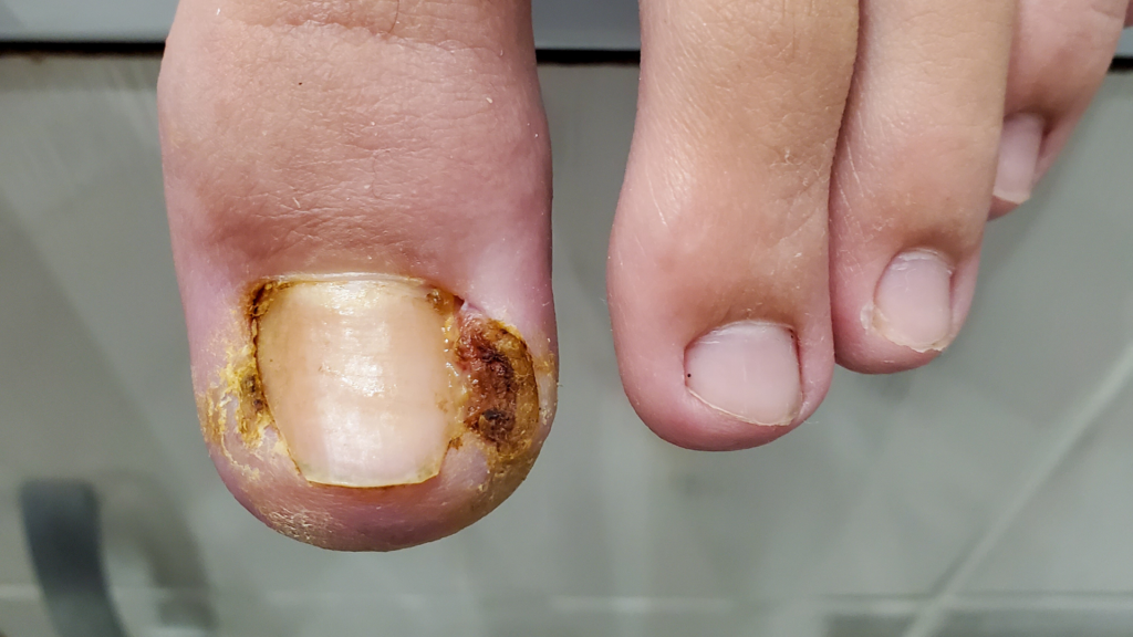 Close-up of a severely infected ingrown toenail with yellowish discharge and skin damage.