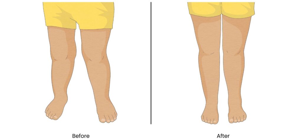 Before and after illustration of a child’s knock knees corrected to straight alignment.
