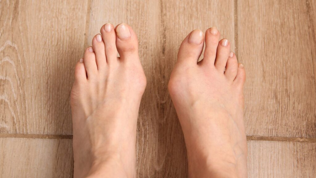 Close-up of bunion on the big toe showing joint misalignment often assessed during biomechanical evaluations.