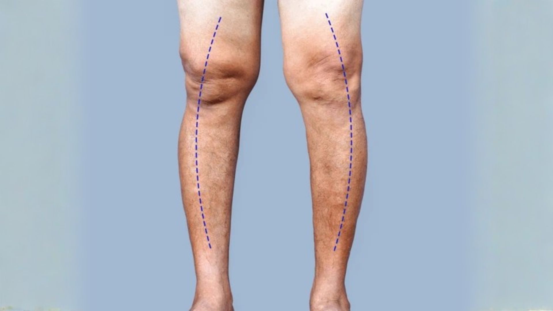 Front view of adult legs with visible bow-legged alignment marked by dotted lines.