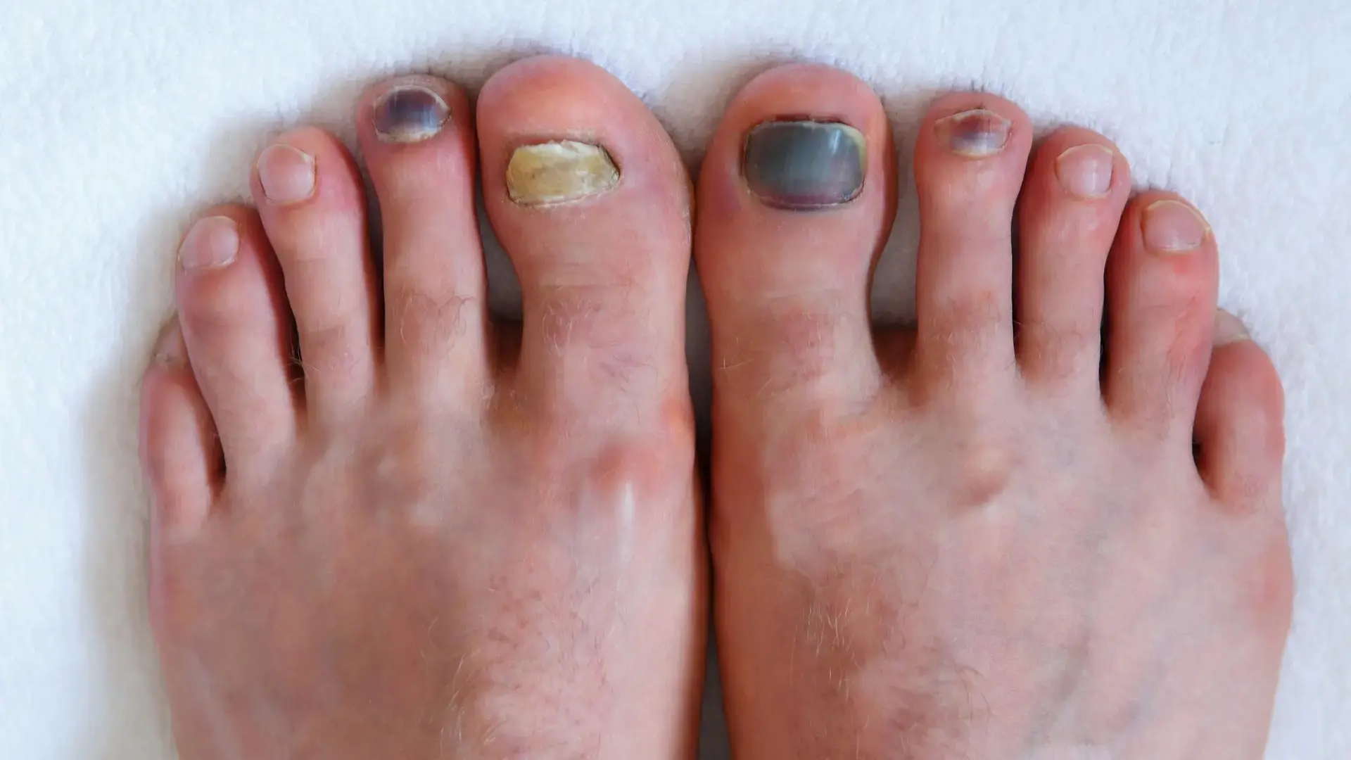 Toenail Fungus Treatment: What Works & When to Get Help