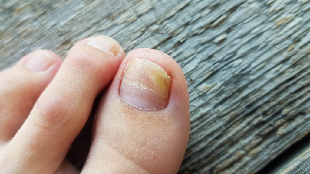 Close-up of a toenail with yellow discoloration and thickening, showing signs of nail fungus.

