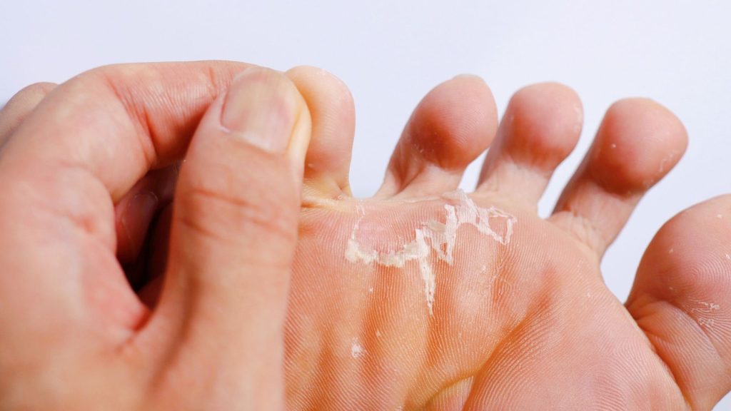 Close-up of peeling skin on the sole of a foot, a common children feet problem affecting skin health