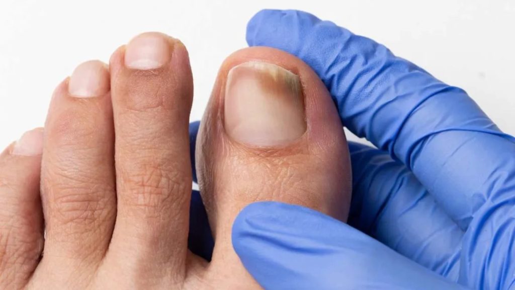 Clinician examining toenails to assess the severity of nail fungus.
