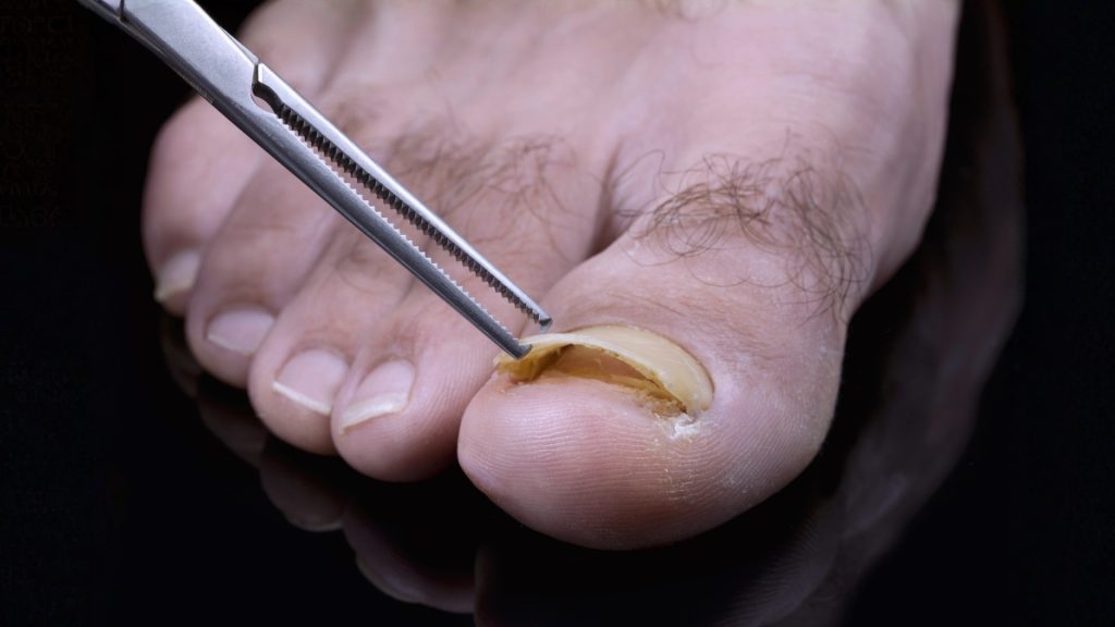Podiatrist removing infected nail debris to reduce fungal load in a damaged toenail.
