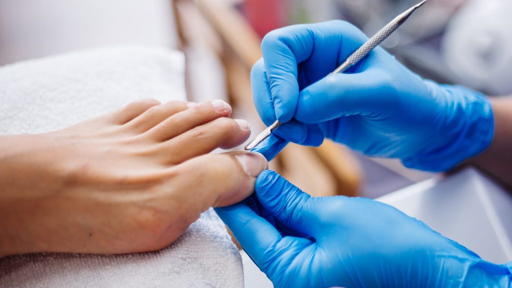 Clinician carefully cleaning and treating a toenail affected by fungal infection.
