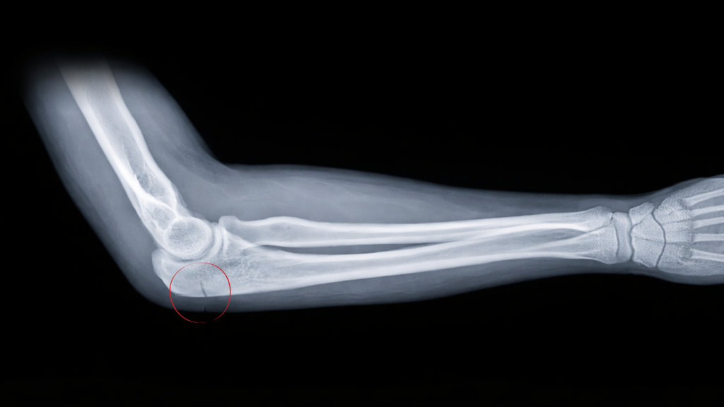 Lateral X-ray of the forearm and elbow showing the elbow joint and surrounding bones, with an area highlighted for injury assessment