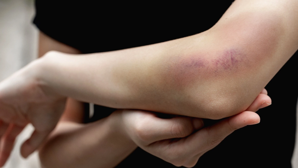Close-up of a bruised elbow with visible swelling and discolouration after an arm injury