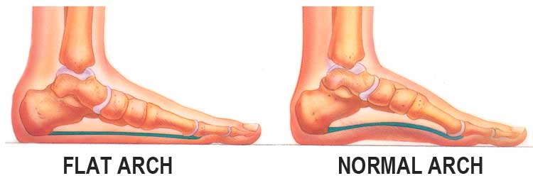 Flat Feet Arch - The Sole Clinic