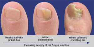 Fungus Toenail - The Sole Clinic