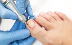 a person removing an ingrown toenail