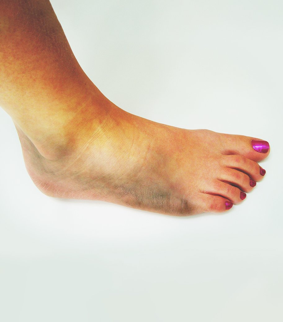 Ankle Sprain Treatment in Singapore Physio & Sole Clinic