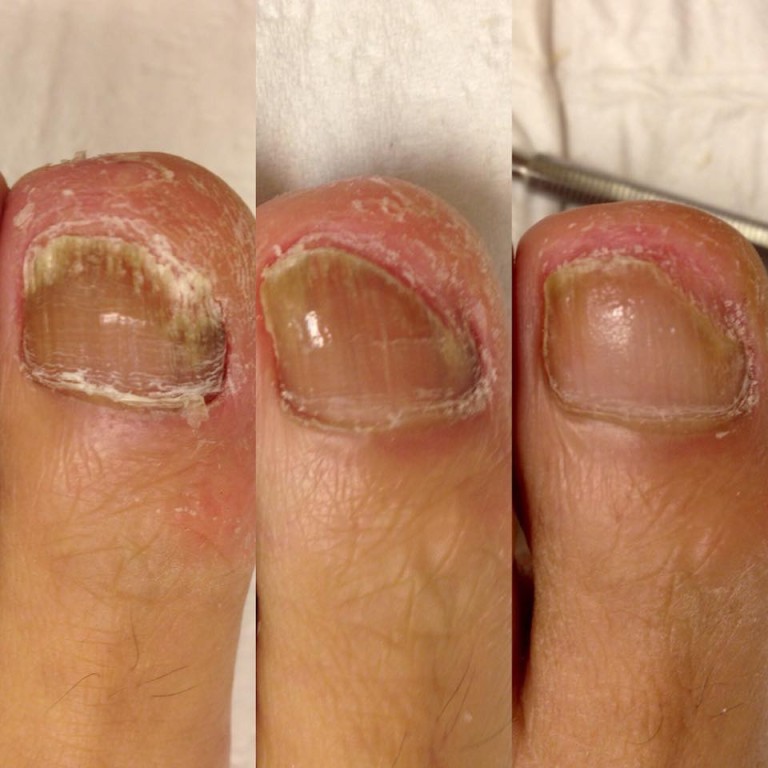 PACT - 20 year old Fungal Problem - The Sole Clinic