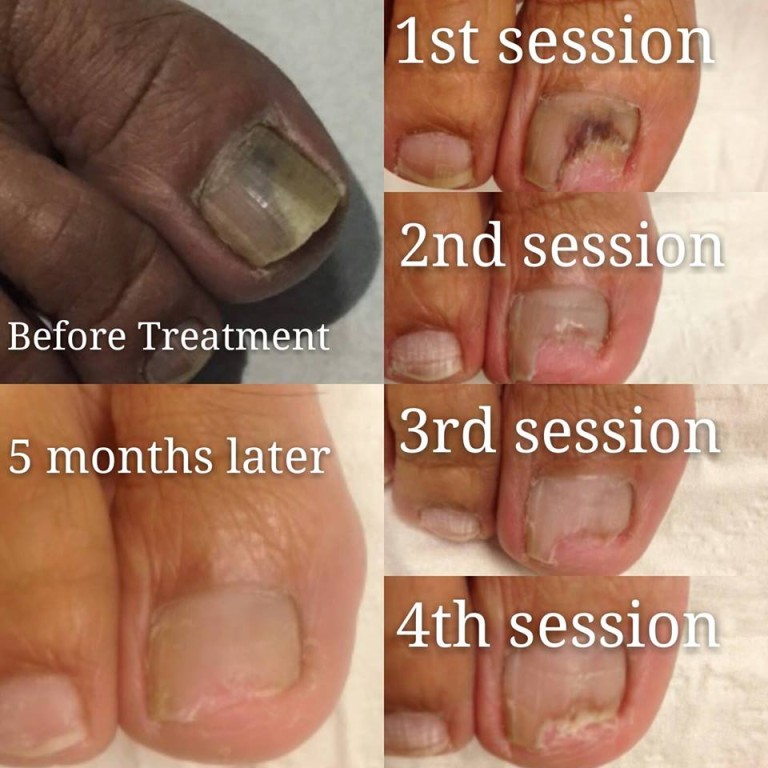 PACT Fungal Problem Progressive - The Sole Clinic