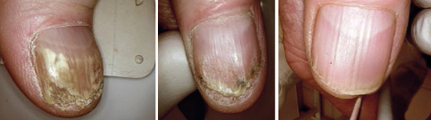 PACT Fungal Problem