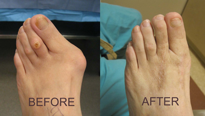 About Bunion - Before and After Surgery - The Sole Clinic
