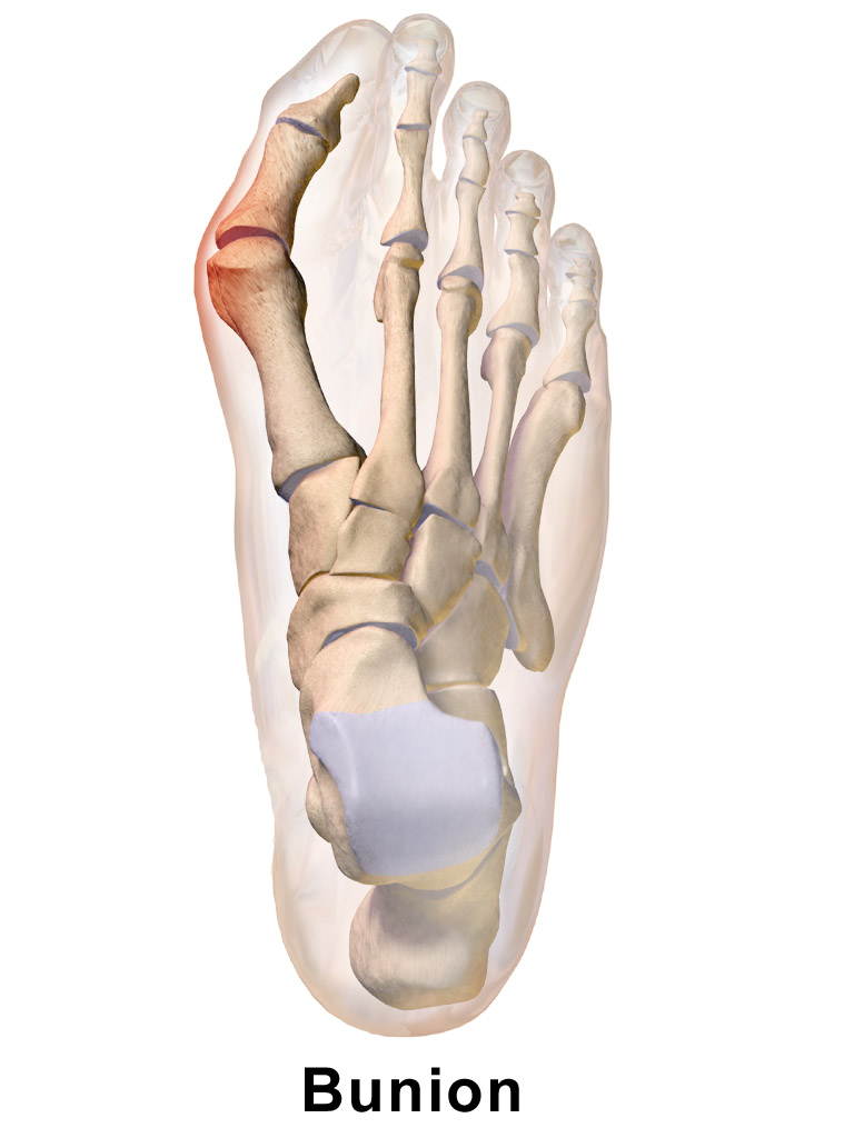 About Bunions - The Sole Clinic