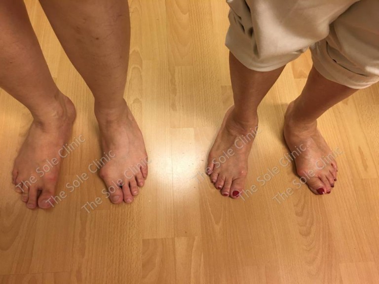 Genetics - About Bunions - The Sole Clinic