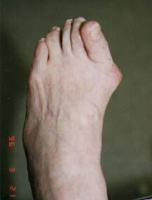 About Bunions - Older Woman with Bunion - The Sole Clinic
