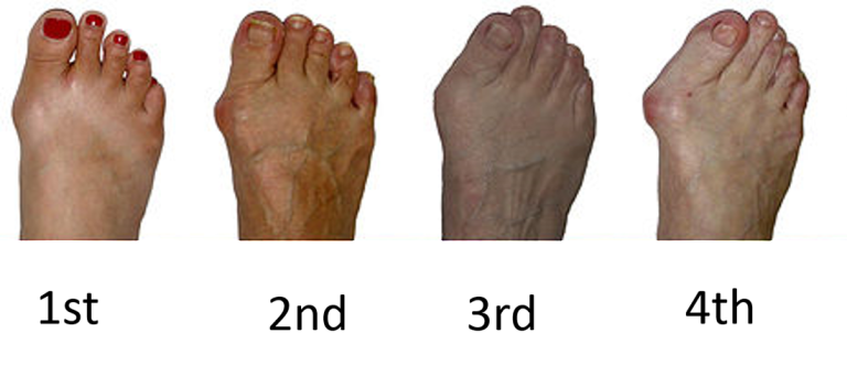 About Bunions - Stages of Development - The Sole Clinic