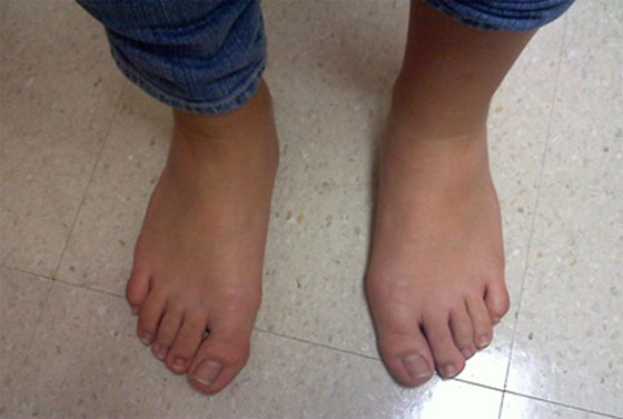 About Bunions - Young Child with Bunion - The Sole Clinic
