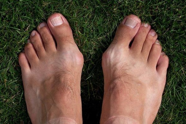 About Bunion - Young Male with Bunion - The Sole Clinic
