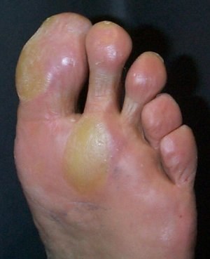 Feet Changing Corns and Calluses - The Sole Clinic