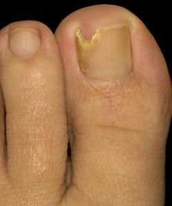 Feet Changing - Fungal Nail Infection