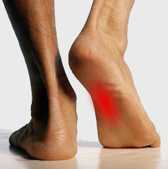 Feet Changing - Painful Arch - The Sole Clinic