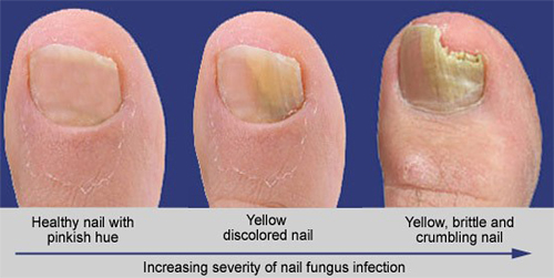 PACT - Fungus Increasing Severity - The Sole Clinic